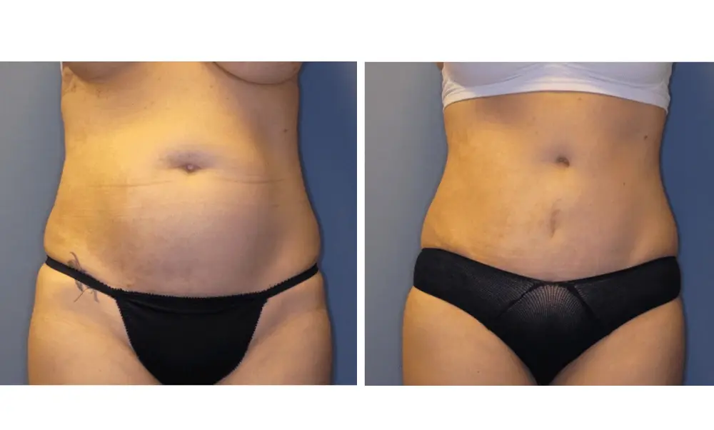 The Plastic Surgeon (Hall) tummy tuck result — Scottsdale, AZ