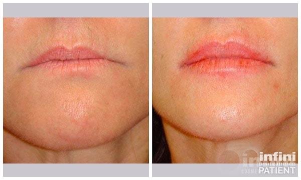 Lip Filler result at The Plastic Surgeon (Hall) in Scottsdale, AZ