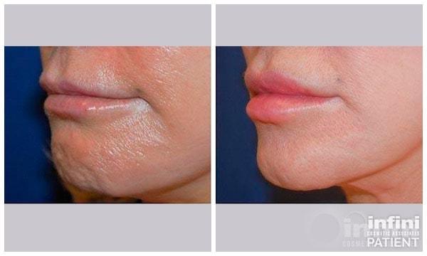 Lip Filler result at The Plastic Surgeon (Hall) in Scottsdale, AZ