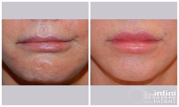 Lip Filler result at The Plastic Surgeon (Hall) in Scottsdale, AZ