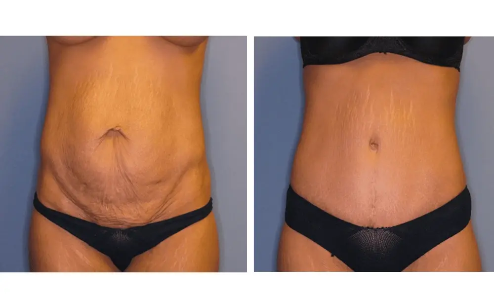 The Plastic Surgeon (Hall) tummy tuck result — Scottsdale, AZ