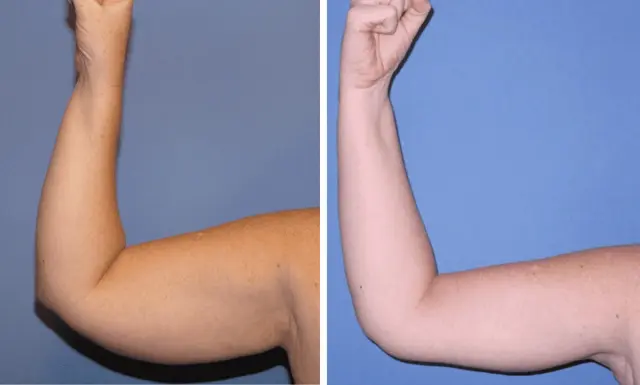 Arm Lift result at The Plastic Surgeon (Hall) in Scottsdale, AZ