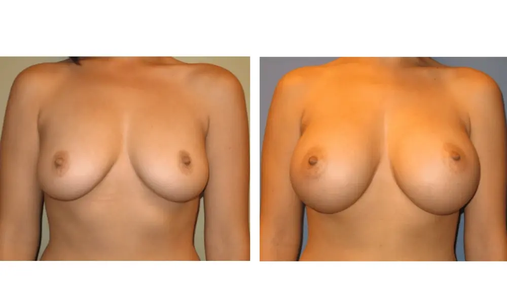 The Plastic Surgeon (Hall) breast augmentation result — Scottsdale, AZ