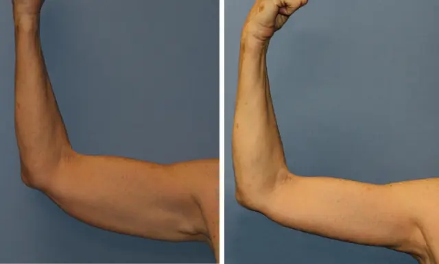 Arm Lift result at The Plastic Surgeon (Hall) in Scottsdale, AZ