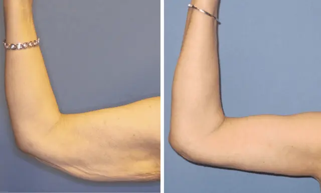 Arm Lift result at The Plastic Surgeon (Hall) in Scottsdale, AZ