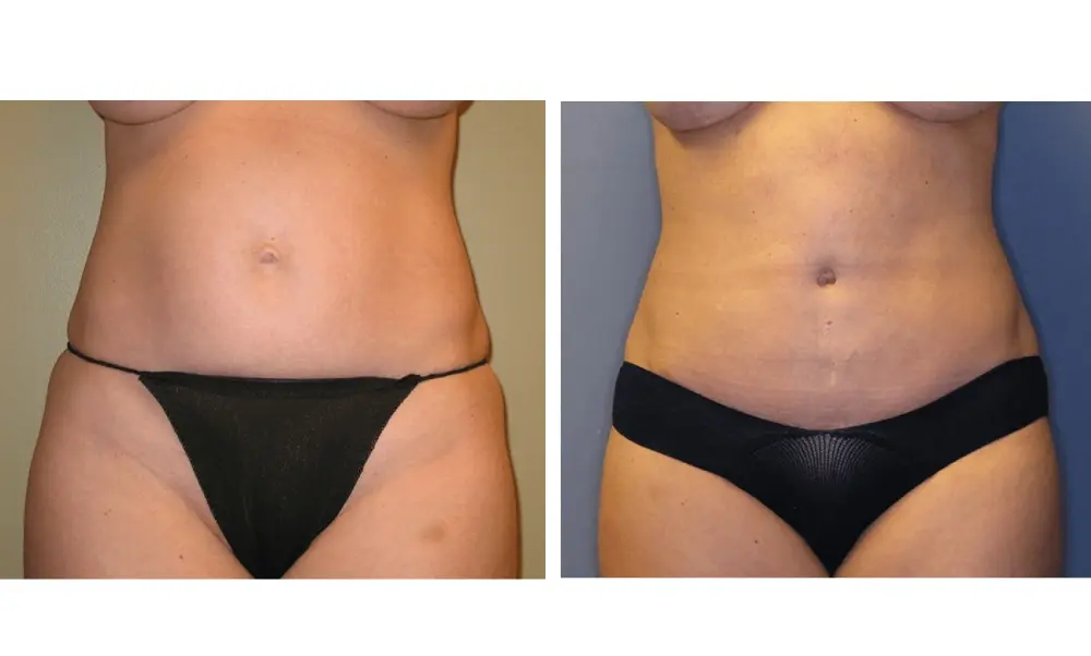The Plastic Surgeon (Hall) tummy tuck result — Scottsdale, AZ