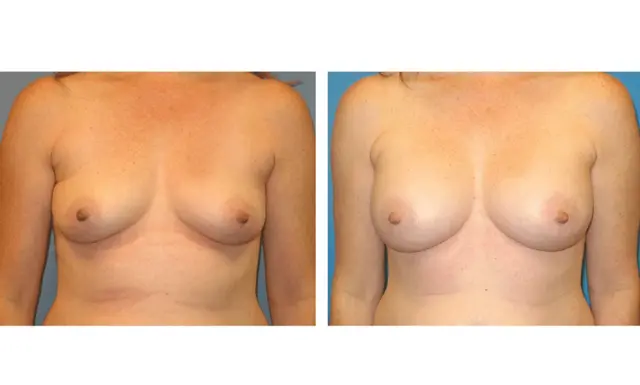 Breast Augmentation result at The Plastic Surgeon (Hall) in Scottsdale, AZ