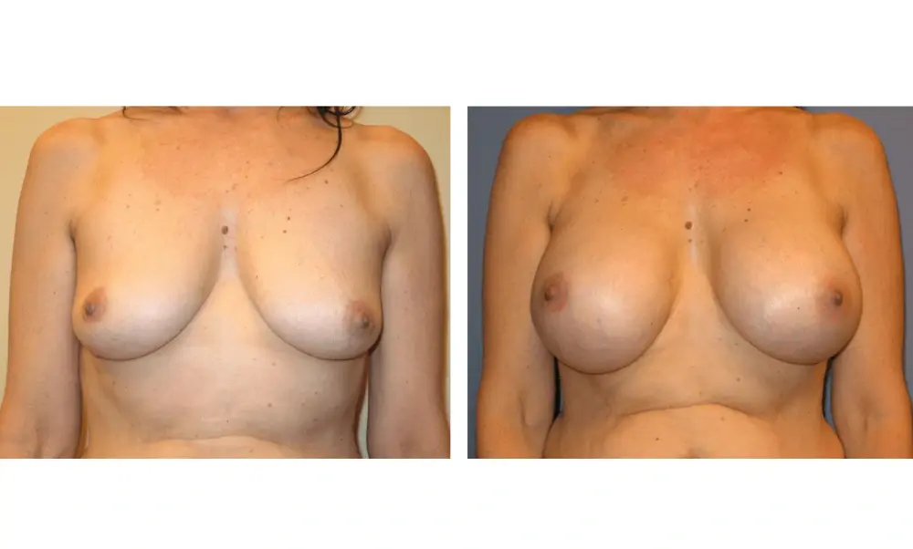The Plastic Surgeon (Hall) breast augmentation result — Scottsdale, AZ
