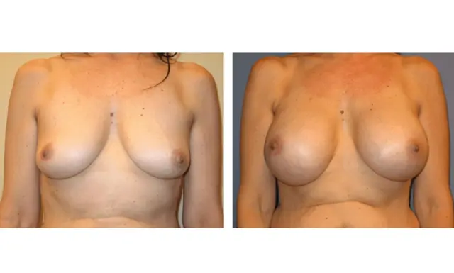 Breast Augmentation result at The Plastic Surgeon (Hall) in Scottsdale, AZ