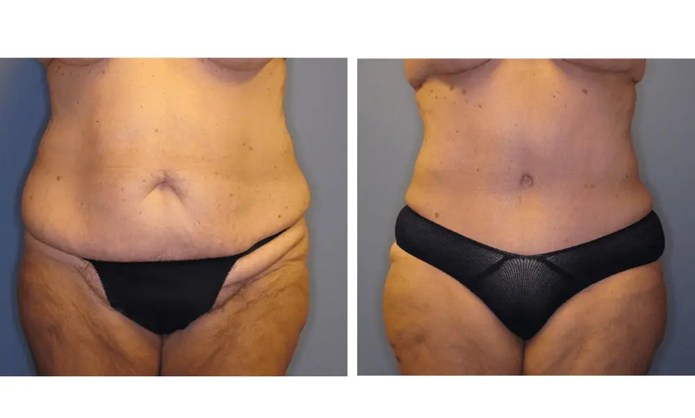 The Plastic Surgeon (Hall) tummy tuck result — Scottsdale, AZ