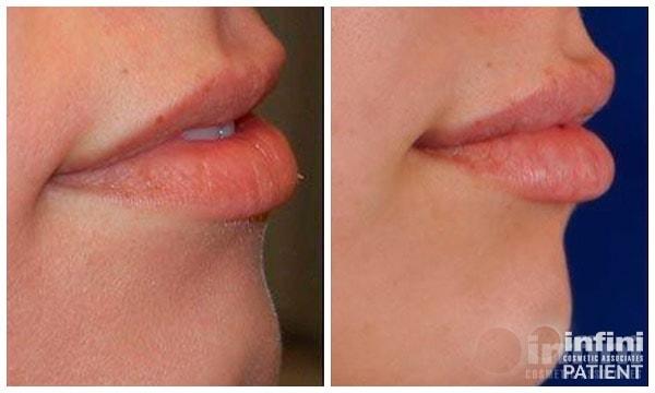 Lip Filler result at The Plastic Surgeon (Hall) in Scottsdale, AZ