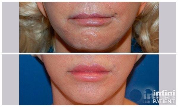 Lip Filler result at The Plastic Surgeon (Hall) in Scottsdale, AZ