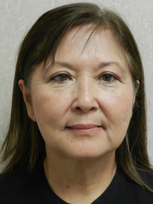 Facelift after at Weston Plastic Surgery (Robert E. Rothfield, MD) in Weston, FL
