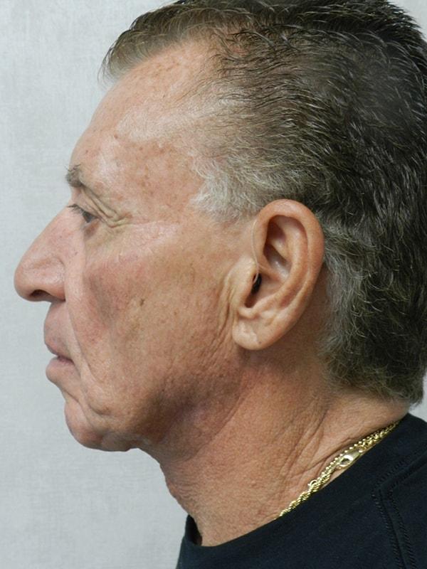 Weston Plastic Surgery (Robert E. Rothfield, MD) neck lift after — Weston, FL