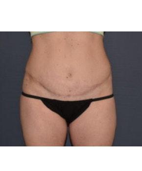 Mommy Makeover after at Mark D. Wigod, MD in Meridian, ID