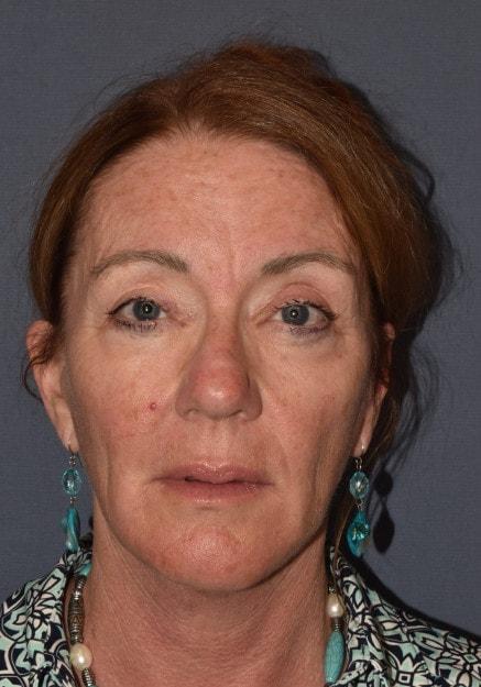 Facelift after at Mark D. Wigod, MD in Meridian, ID