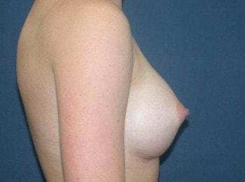 Fat Transfer Breast Augmentation after at Mark D. Wigod, MD in Meridian, ID