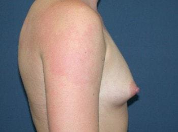 Fat Transfer Breast Augmentation before at Mark D. Wigod, MD in Meridian, ID