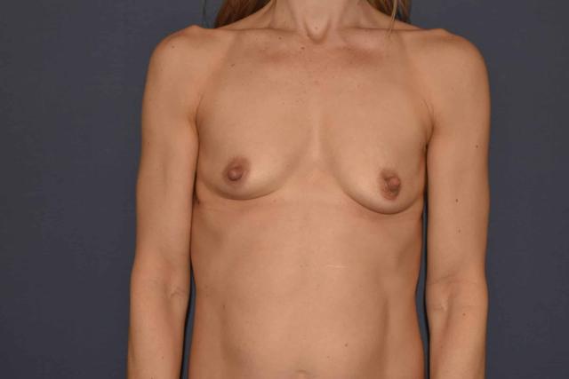 Fat Transfer Breast Augmentation before at Mark D. Wigod, MD in Meridian, ID