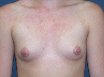 Fat Transfer Breast Augmentation before at Mark D. Wigod, MD in Meridian, ID