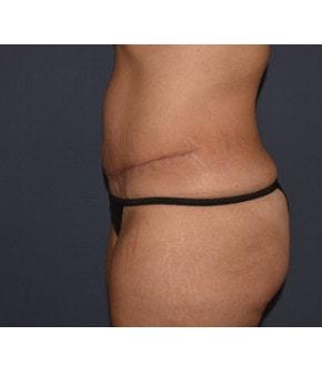 Mark D. Wigod, MD tummy tuck after — Meridian, ID
