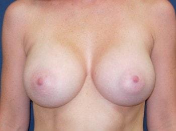 Fat Transfer Breast Augmentation after at Mark D. Wigod, MD in Meridian, ID