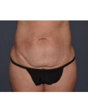 Mini Tummy Tuck before at Mark D. Wigod, MD in Meridian, ID