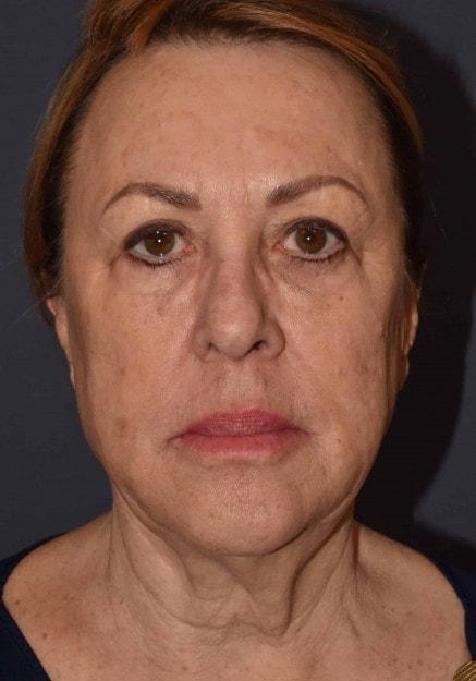 Facelift before at Mark D. Wigod, MD in Meridian, ID