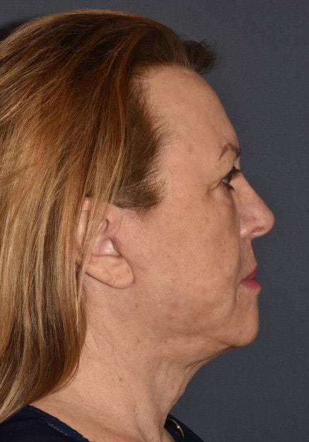 Facelift after at Mark D. Wigod, MD in Meridian, ID