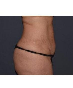 Mommy Makeover before at Mark D. Wigod, MD in Meridian, ID