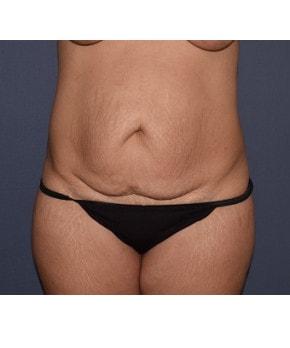 Mini Tummy Tuck before at Mark D. Wigod, MD in Meridian, ID