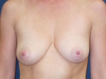 Fat Transfer Breast Augmentation before at Mark D. Wigod, MD in Meridian, ID