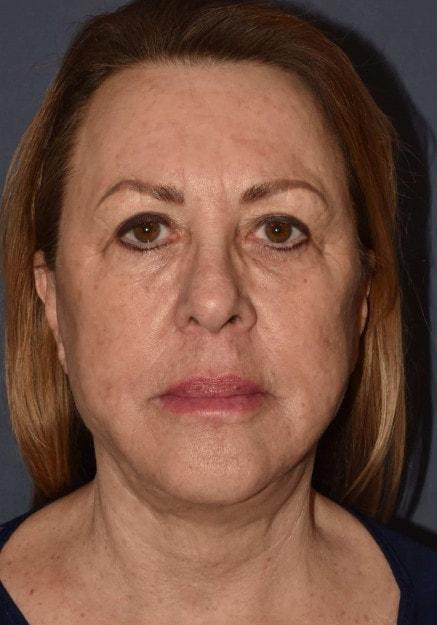 Facelift after at Mark D. Wigod, MD in Meridian, ID