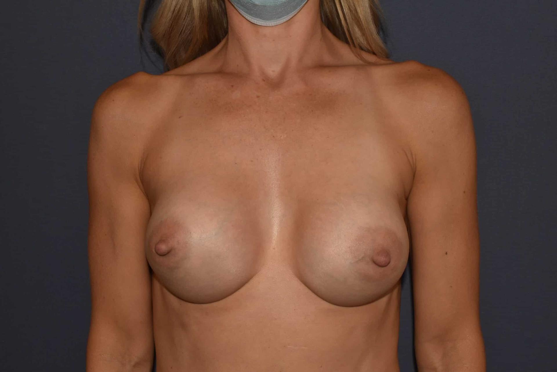 Mark D. Wigod, MD breast augmentation after — Meridian, ID