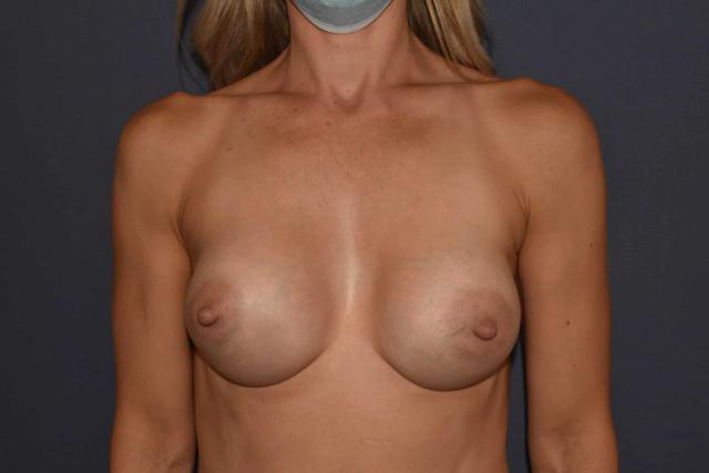 Fat Transfer Breast Augmentation after at Mark D. Wigod, MD in Meridian, ID