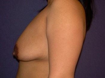 Breast Lift before at Mark D. Wigod, MD in Meridian, ID