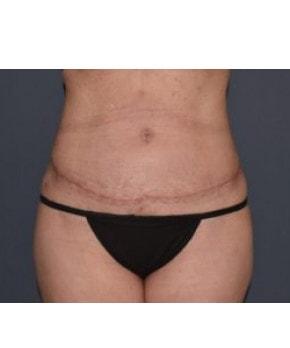 Mini Tummy Tuck after at Mark D. Wigod, MD in Meridian, ID