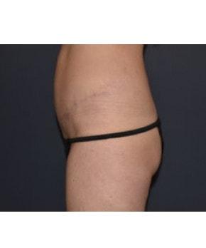 Mark D. Wigod, MD tummy tuck after — Meridian, ID