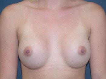 Fat Transfer Breast Augmentation after at Mark D. Wigod, MD in Meridian, ID