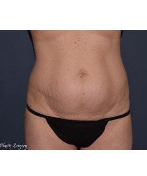 Mommy Makeover before at Mark D. Wigod, MD in Meridian, ID