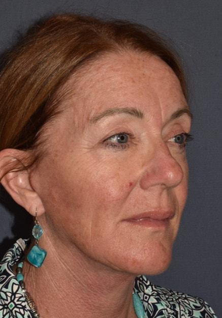 Mini Facelift after at Mark D. Wigod, MD in Meridian, ID