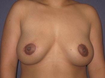 Mark D. Wigod, MD breast lift after — Meridian, ID