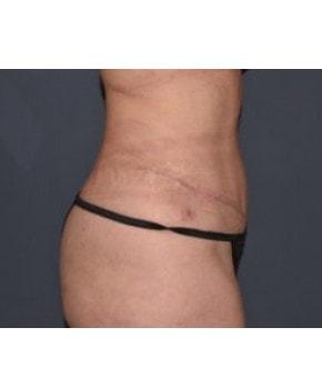 Mark D. Wigod, MD tummy tuck after — Meridian, ID