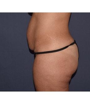 Mini Tummy Tuck before at Mark D. Wigod, MD in Meridian, ID