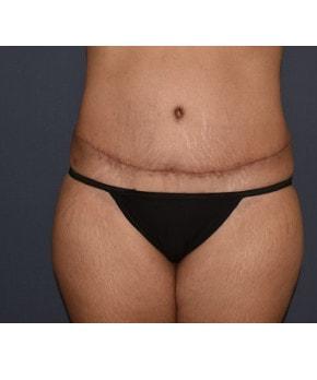 Mini Tummy Tuck after at Mark D. Wigod, MD in Meridian, ID