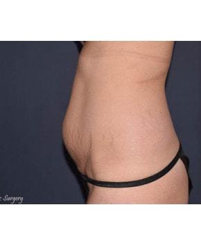 Mommy Makeover before at Mark D. Wigod, MD in Meridian, ID