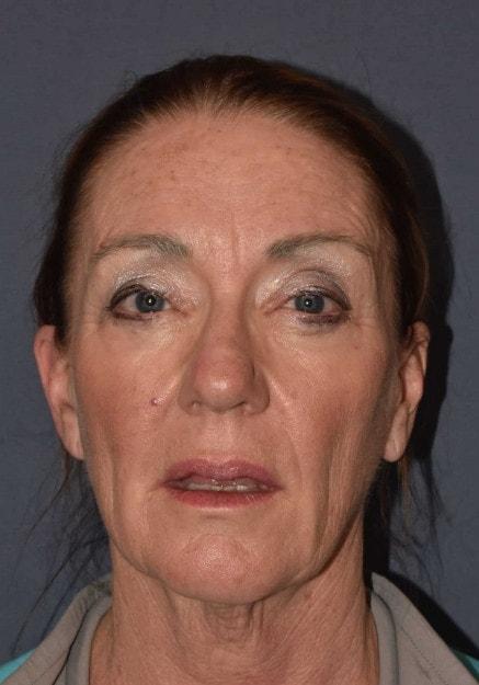Facelift before at Mark D. Wigod, MD in Meridian, ID