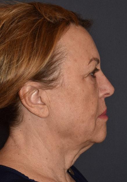 Facelift before at Mark D. Wigod, MD in Meridian, ID