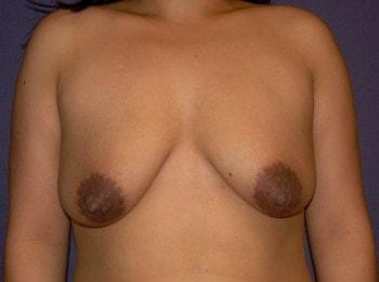Breast Lift before at Mark D. Wigod, MD in Meridian, ID
