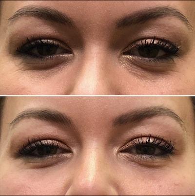 Umbareen Mahmood, MD under-eye filler result — New York, NY